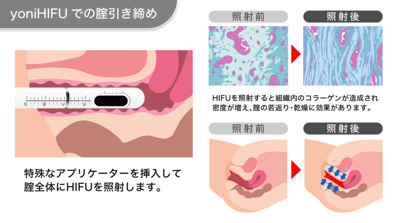 HIFU膣縮小